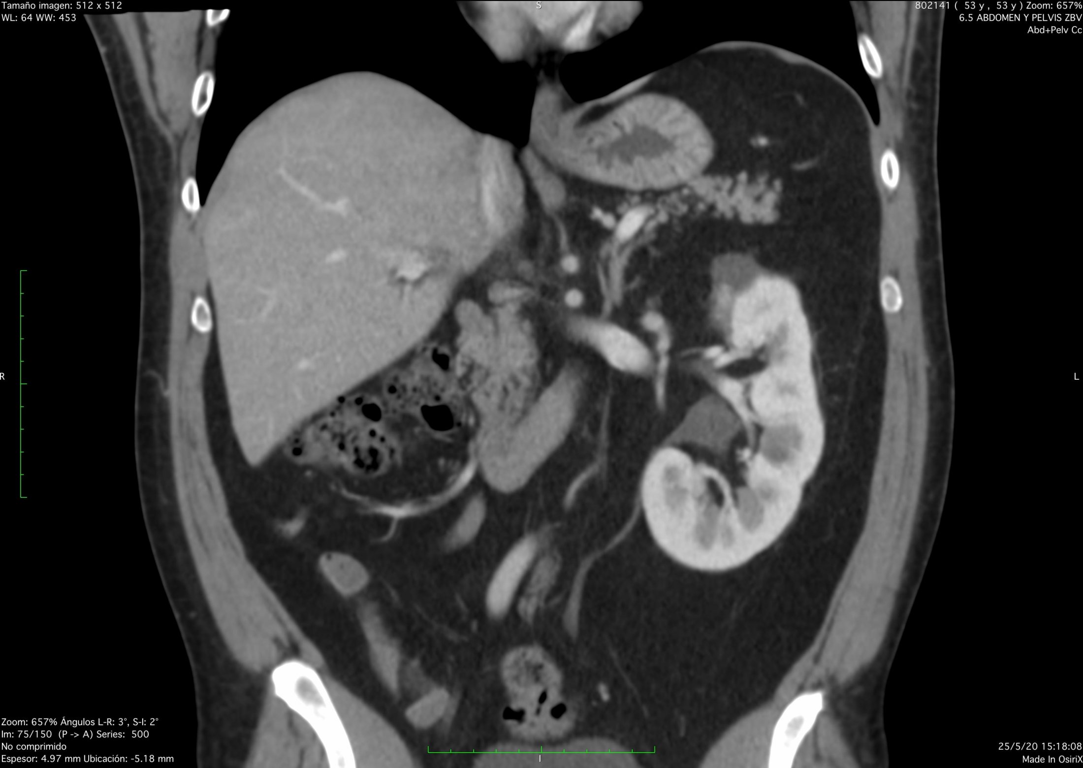 Tomografía – VAFOBOL